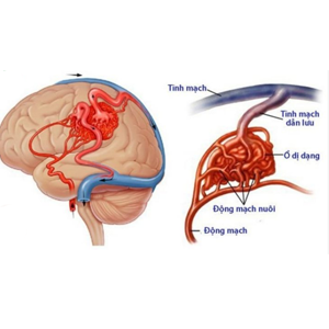 Xuất huyết não